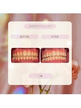 プラスビーセルフ(+b self)/ホワイトニングビフォーアフター