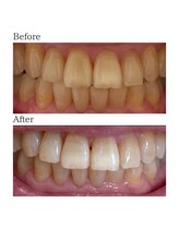 ノーブル 上土店(Noble)/ホワイトニングBeforeAfter