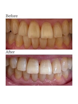ノーブル 上土店(Noble)/ホワイトニングBeforeAfter