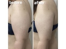 アヤエステティックサロン 綱島店(AYA)/気になる二の腕もスッキリ！