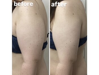 アヤエステティックサロン 綱島店(AYA)/気になる二の腕もスッキリ！