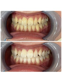 グリッター ショウナン(glitter. SHONAN)/藤沢ホワイトニングbefore/after