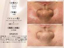 アクール(Accueil)/【毛穴黒ずみ、毛穴ケア】