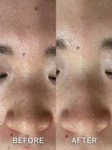 ベルミーランド マルエツ安行慈林/毛穴ケアBeforeAfter