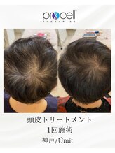 ユミト(Umit)/プロセルスカルプ