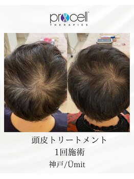 ユミト(Umit)/プロセルスカルプ