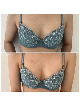 モア(moa)/バストアップ症例