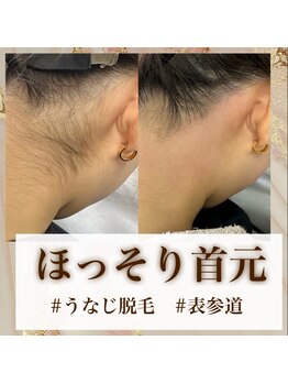 ギューテ(Gute)/うなじ脱毛