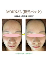 アイリス(AIRIS)/毛穴洗浄/ニキビケア/シミケア