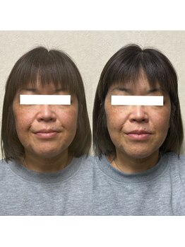 ジャスミン(Jasmine)/頭蓋骨小顔矯正