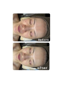 エクラ(ECLAT)/レストセルトリートメント