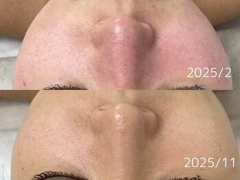 アンリミット 原宿竹下通り店(Une limit)/9ヶ月肌質改善経過 before after