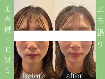 ビープラス(BEE PLUS)/食いしばりによるエラ張り