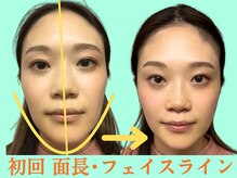 ナチュラルパーフェクトフェイス 新宿/３０才・初回・面長・左右差