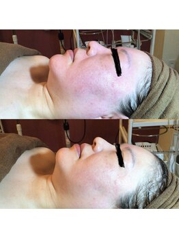 ディア スプリーマ/4回1度レストセルトリートメント