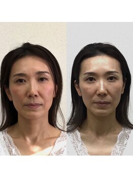 オズ六本木/六本木小顔矯正(造顔)施術1回