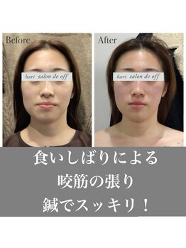 ハリサロンドオフ 心斎橋店(hari salon de off)/エラ・頬骨の張りも緩和♪