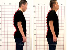 よしかわ整体院/反り腰と極度の猫背