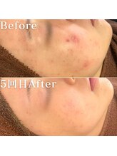 ミニョスキンラボ/韓国式ハーブピーリング5回