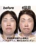 【あと2名】幹細胞美容鍼モニター募集！たるみ・しわケアに（40代以降の方）