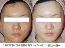 ピュアノア 垂水店/肌質改善フェイシャル　神戸垂水