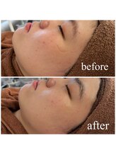 ミラ 中央林間(mira)/小顔　毛穴　ホワイトニング