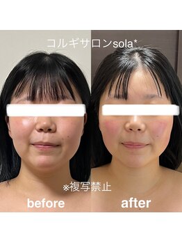 ソラ(sola*)/マイナス3kg見え!小顔コルギ♪