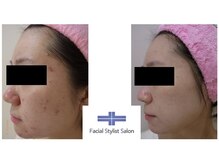 フェイシャルスタイリストサロン 高崎店(Facial Stylist Salon)/ケア例（51）