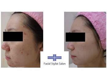 フェイシャルスタイリストサロン 高崎店(Facial Stylist Salon)/ケア例(51)