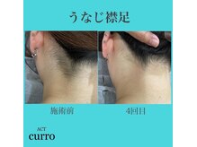 アクト クロ(ACT curro)/【うなじ襟足】脱毛施術例
