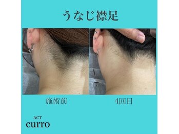 アクト クロ(ACT curro)/【うなじ襟足】脱毛施術例