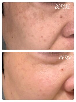 エタニティ 西宮店(Eternity)/韓国ハーブピーリング