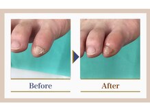 巻き爪補正店 錦糸町店/【副爪ケア】