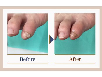 巻き爪補正店 錦糸町店/【副爪ケア】