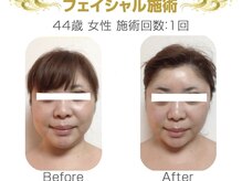 リラエス(Rela S)/一度の施術で効果実感！