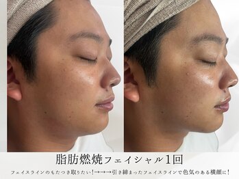 ミヨンラボ(miyon LABO)/小顔フェイシャル1回