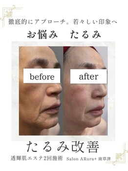 アルルプラス 南草津(ARuru+)/【肌改善】ビフォーアフター
