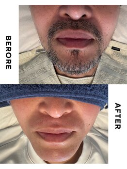 アマカ(Amaka)の写真/メンズ脱毛は完全個室で◎「剃らずに来店OK」！ワックス×光脱毛で速攻ツルツル肌を実感♪