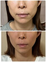 オウカ(OUKA)/貼る糸リフト&脂肪分解施術後