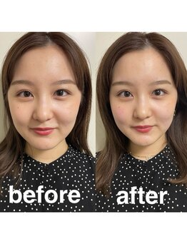 マホロバ(mahoroba)/美容鍼+頭皮鍼