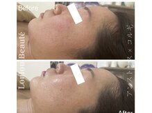 ルルボーテ(Loulou Beaute)/アンストレス×コルギ