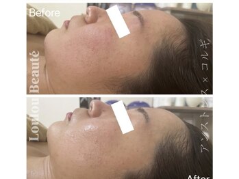 ルルボーテ(Loulou Beaute)/アンストレス×コルギ