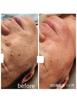 ルオント(LUONTO)/シミケア×光フェイシャル