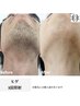 メンズ【ヒゲ】脱毛 初回¥3,900『根強いヒゲ１度で実感』（担当hiro