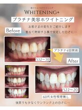 ホワイトニングプラス(Whitening+)/プラチナ美容ホワイトニング
