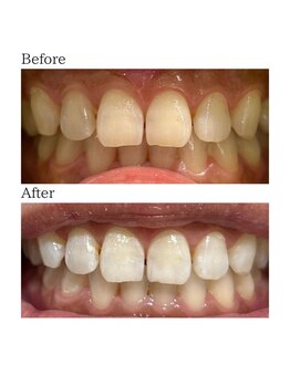 ノーブル 上土店(Noble)/ホワイトニングBeforeAfter