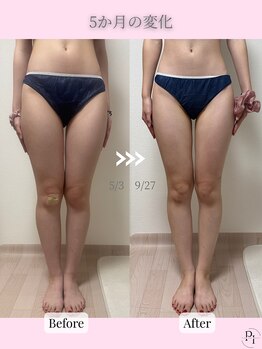 プラスワンビューティテン 新大阪店(Plus One Beauty)/ボディ/ハイパーナイフ/痩身