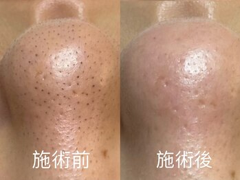 ルミエール 新宿(Lumierre)/ハーブピーリング+毛穴洗浄