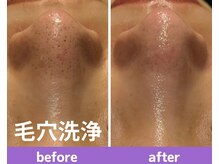 アンブル(Ambre)/毛穴洗浄