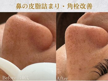 ぷるる 練馬 江古田/40代 毛穴洗浄+ララピール導入